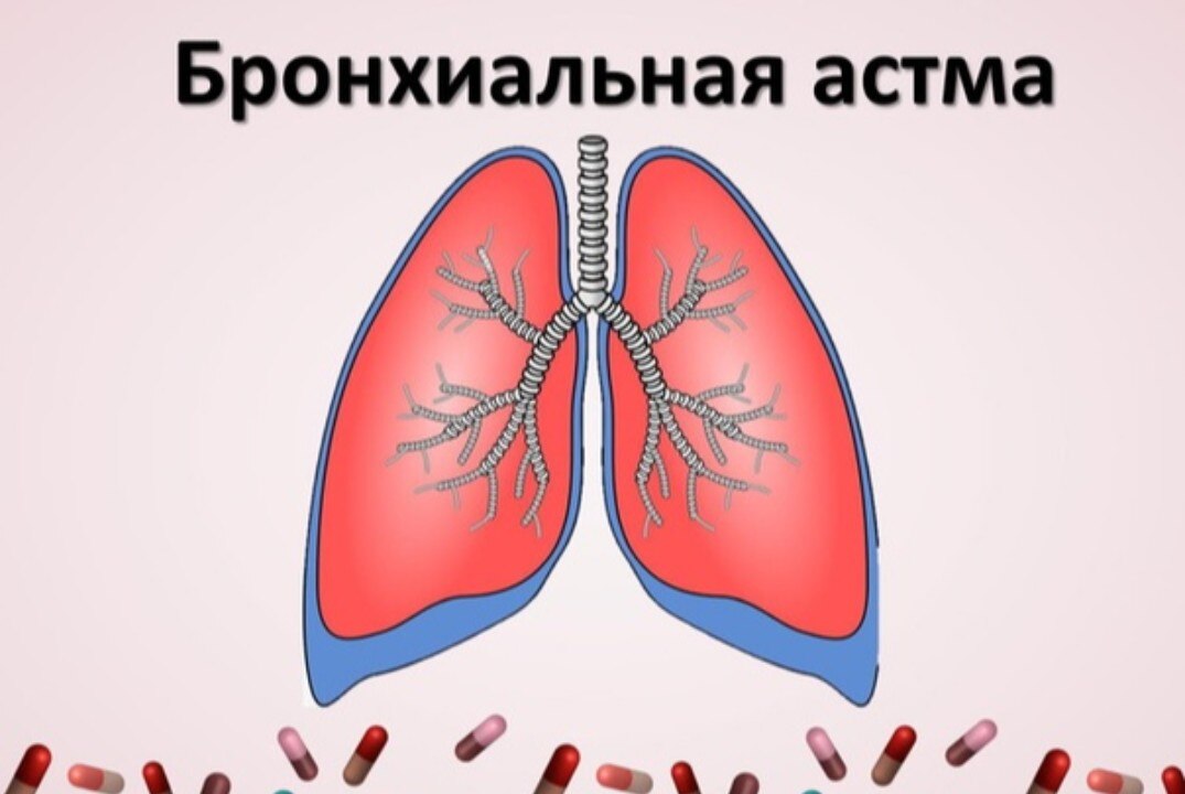 Бронхиальная астма: диагностика и лечение.