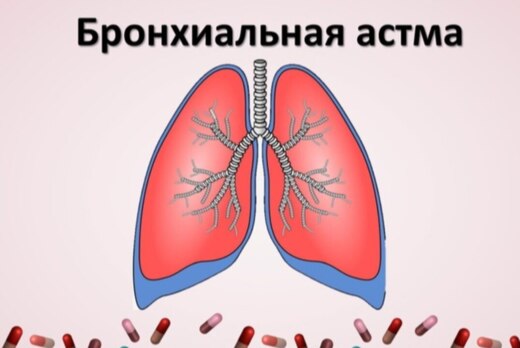 Бронхиальная астма: диагностика и лечение.